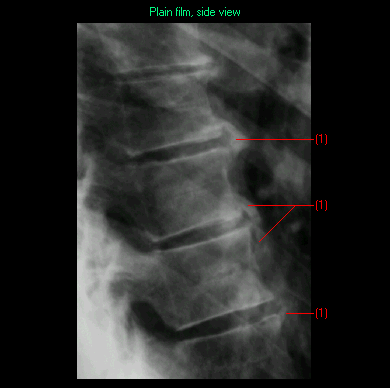Image of DISH of the spine (Forestier disease)